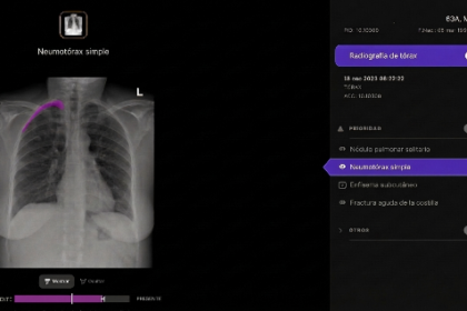 Telefónica y Harrison.ai se alían para apoyar el diagnóstico en radiografías