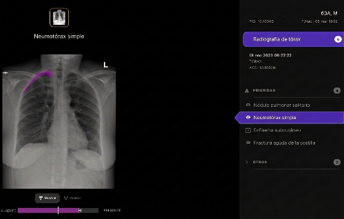 Telefónica y Harrison.ai se alían para apoyar el diagnóstico en radiografías